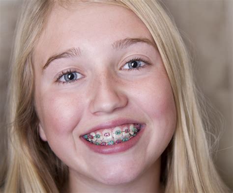 Self-ligating <strong>braces</strong>: $2,000 to $7,000. . Blow job braces